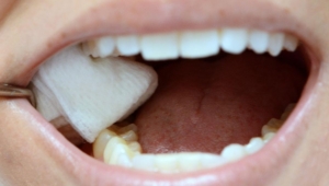 Post-Tooth Extraction Care