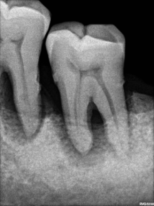 NDRYSHIMET NË PARODONCIUM PËR SHKAK TË HIPERFUNKSIONIT